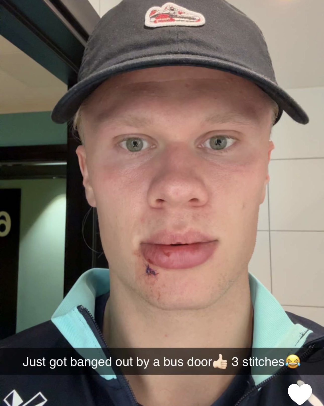 yl23455永利官网-😂被门夹了？哈兰德晒照：让大巴车门打到嘴，缝了三针